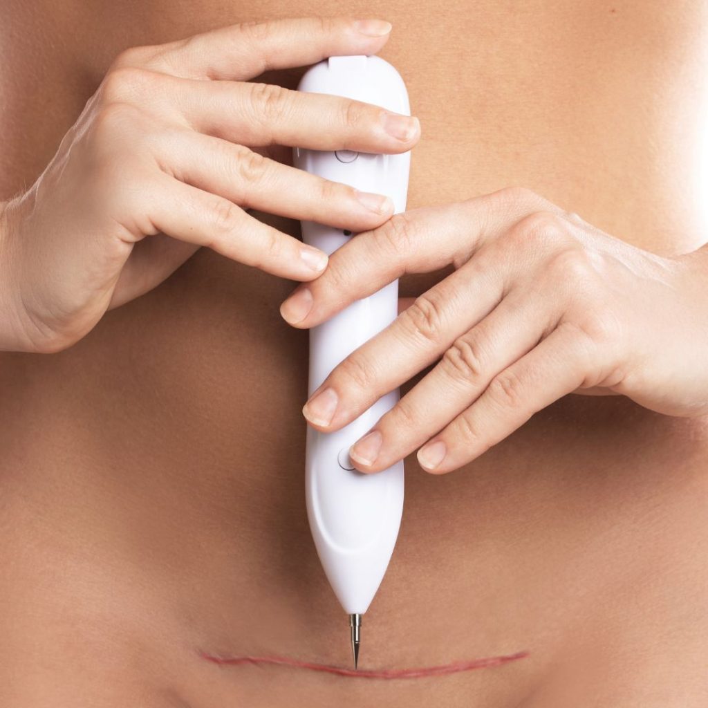 Plasma Pen Anwendungsbereich