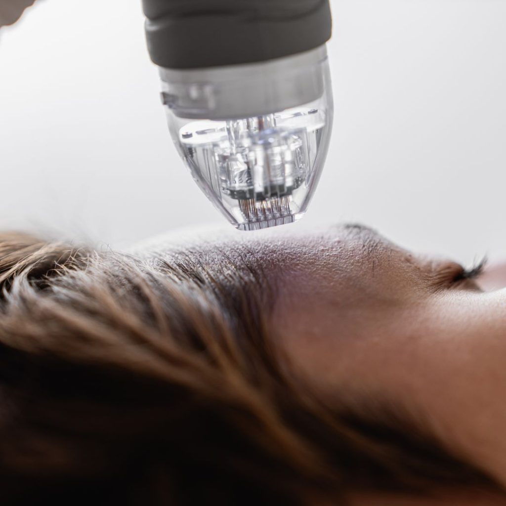 Radifrequenz Needling
