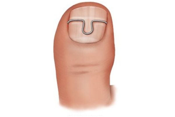 Erste Nagelspange