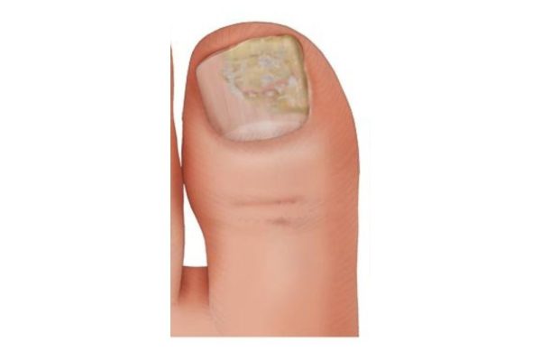 Pilznagelbehandlung